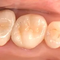 むし歯治療 症例紹介｜岡山市北区の歯医者【グラン岡山歯科・矯正歯科】インプラントから虫歯治療まで幅広く対応