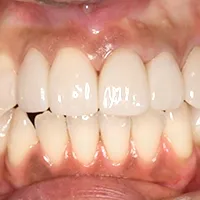 審美歯科 症例紹介｜岡山市北区の歯医者【グラン岡山歯科・矯正歯科】インプラントから虫歯治療まで幅広く対応