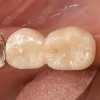 インプラント治療 症例紹介｜岡山市北区の歯医者【グラン岡山歯科・矯正歯科】インプラントから虫歯治療まで幅広く対応