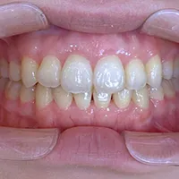 インビザライン 症例紹介｜岡山市北区の歯医者【グラン岡山歯科・矯正歯科】インプラントから虫歯治療まで幅広く対応