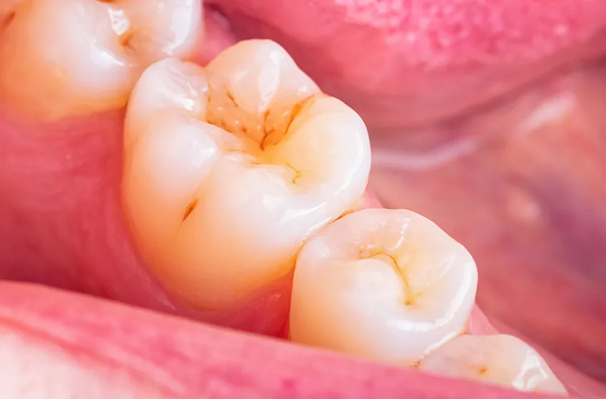 むし歯治療 CO|岡山市北区の歯医者【グラン岡山歯科・矯正歯科】インプラントから虫歯治療まで幅広く対応