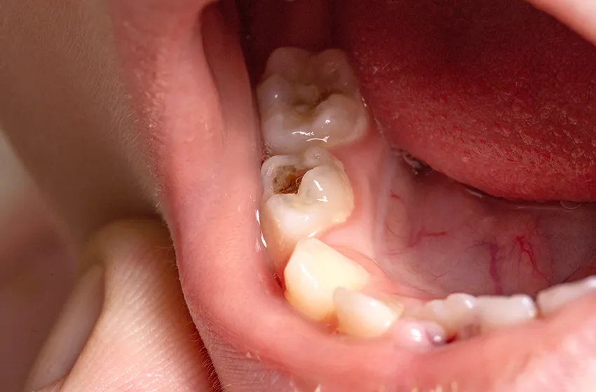 むし歯治療 C1 C2|岡山市北区の歯医者【グラン岡山歯科・矯正歯科】インプラントから虫歯治療まで幅広く対応