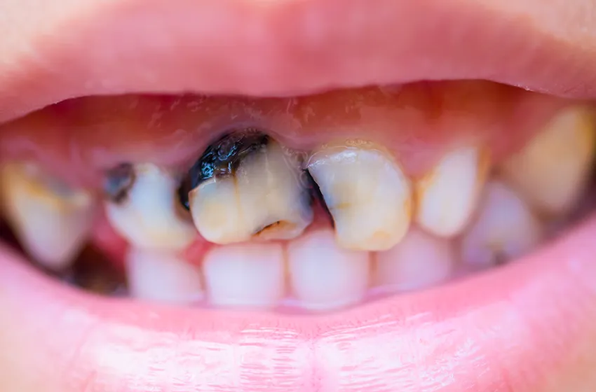 むし歯治療 C3|岡山市北区の歯医者【グラン岡山歯科・矯正歯科】インプラントから虫歯治療まで幅広く対応