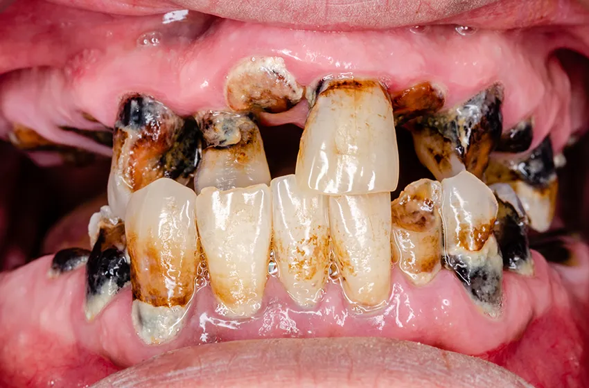 むし歯治療 C4|岡山市北区の歯医者【グラン岡山歯科・矯正歯科】インプラントから虫歯治療まで幅広く対応