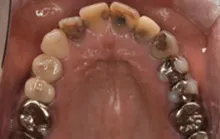 症例 治療前 審美歯科｜岡山市北区の歯医者【グラン岡山歯科・矯正歯科】インプラントから虫歯治療まで幅広く対応