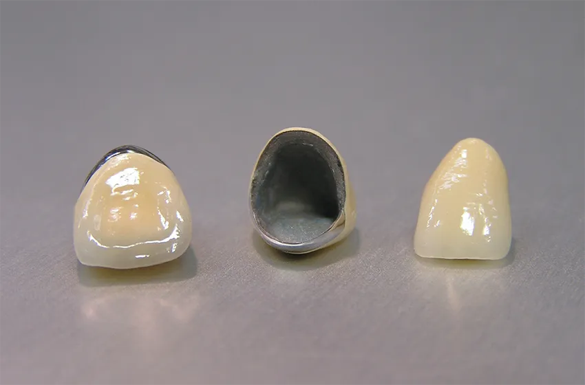 審美歯科 メタルボンド|岡山市北区の歯医者【グラン岡山歯科・矯正歯科】インプラントから虫歯治療まで幅広く対応