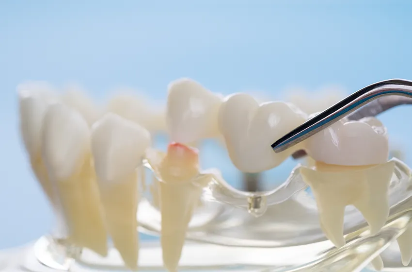 インプラント治療 ブリッジ|岡山市北区の歯医者【グラン岡山歯科・矯正歯科】インプラントから虫歯治療まで幅広く対応