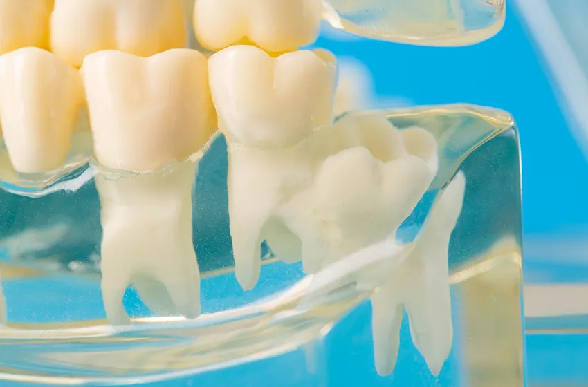 歯科口腔外科 親知らず|岡山市北区の歯医者【グラン岡山歯科・矯正歯科】インプラントから虫歯治療まで幅広く対応