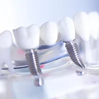 インプラント治療 症例紹介｜岡山市北区の歯医者【グラン岡山歯科・矯正歯科】インプラントから虫歯治療まで幅広く対応