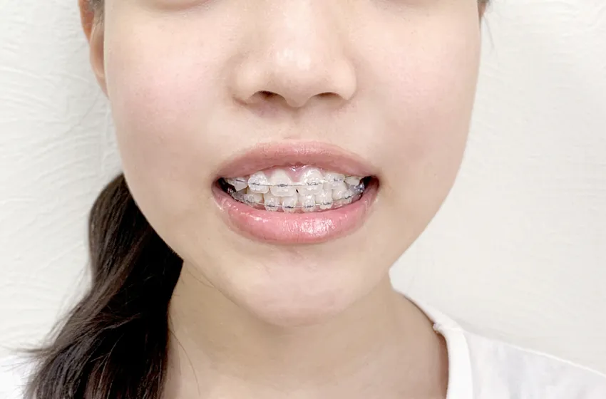 小児矯正 マルチブラケット|成長に合わせた治療|岡山市北区の歯医者【グラン岡山歯科・矯正歯科】インプラントから虫歯治療まで幅広く対応