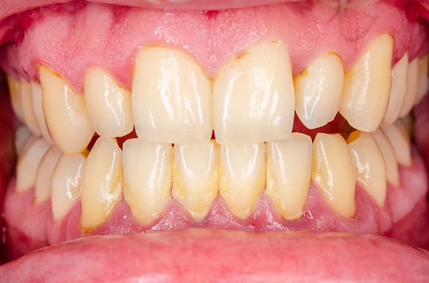 歯周病 歯周病治療|岡山市北区の歯医者【グラン岡山歯科・矯正歯科】インプラントから虫歯治療まで幅広く対応