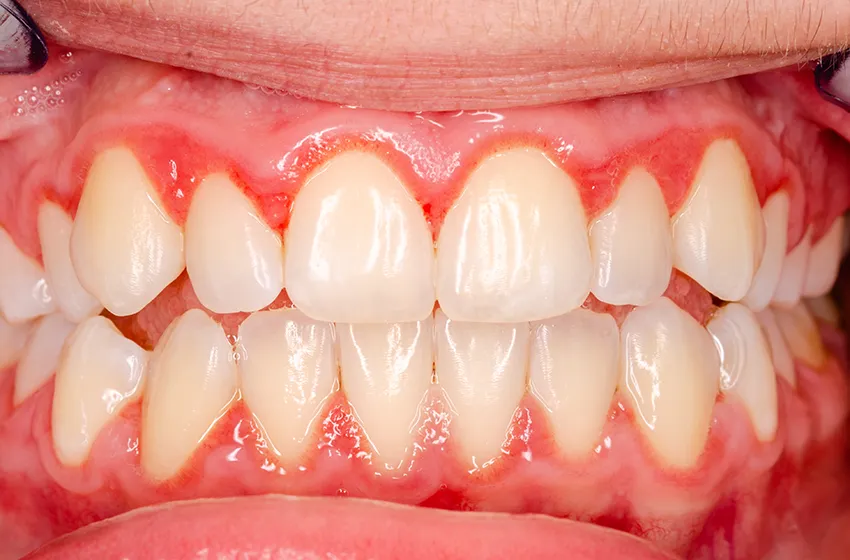 歯周病 歯肉炎|岡山市北区の歯医者【グラン岡山歯科・矯正歯科】インプラントから虫歯治療まで幅広く対応