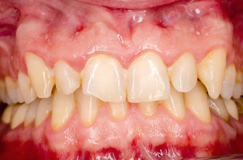 歯周病 初期型歯周炎|岡山市北区の歯医者【グラン岡山歯科・矯正歯科】インプラントから虫歯治療まで幅広く対応