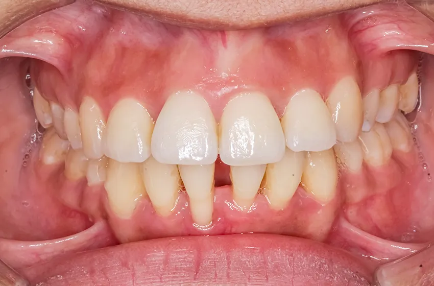 歯周病 中間期歯周炎|岡山市北区の歯医者【グラン岡山歯科・矯正歯科】インプラントから虫歯治療まで幅広く対応