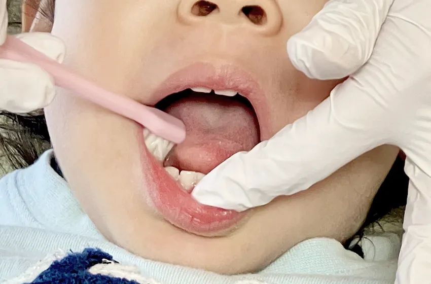 メンテナンス 予防歯科 フッ素塗布|岡山市北区の歯医者【グラン岡山歯科・矯正歯科】インプラントから虫歯治療まで幅広く対応